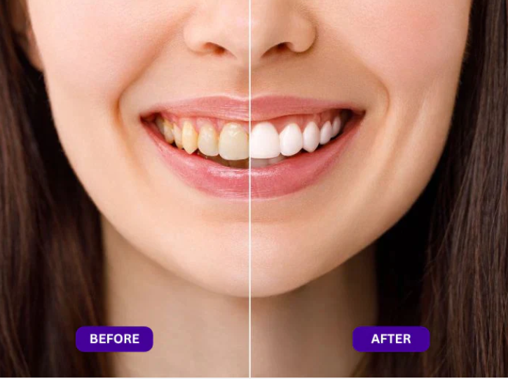Purple Whitening Strips